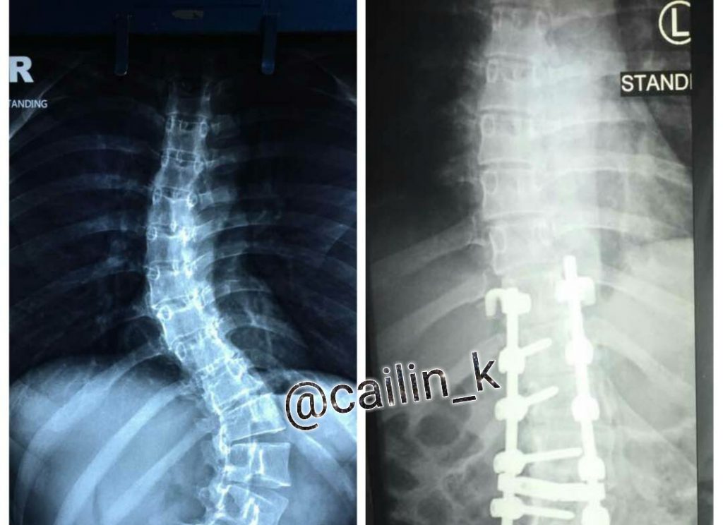 Swimming With Scoliosis